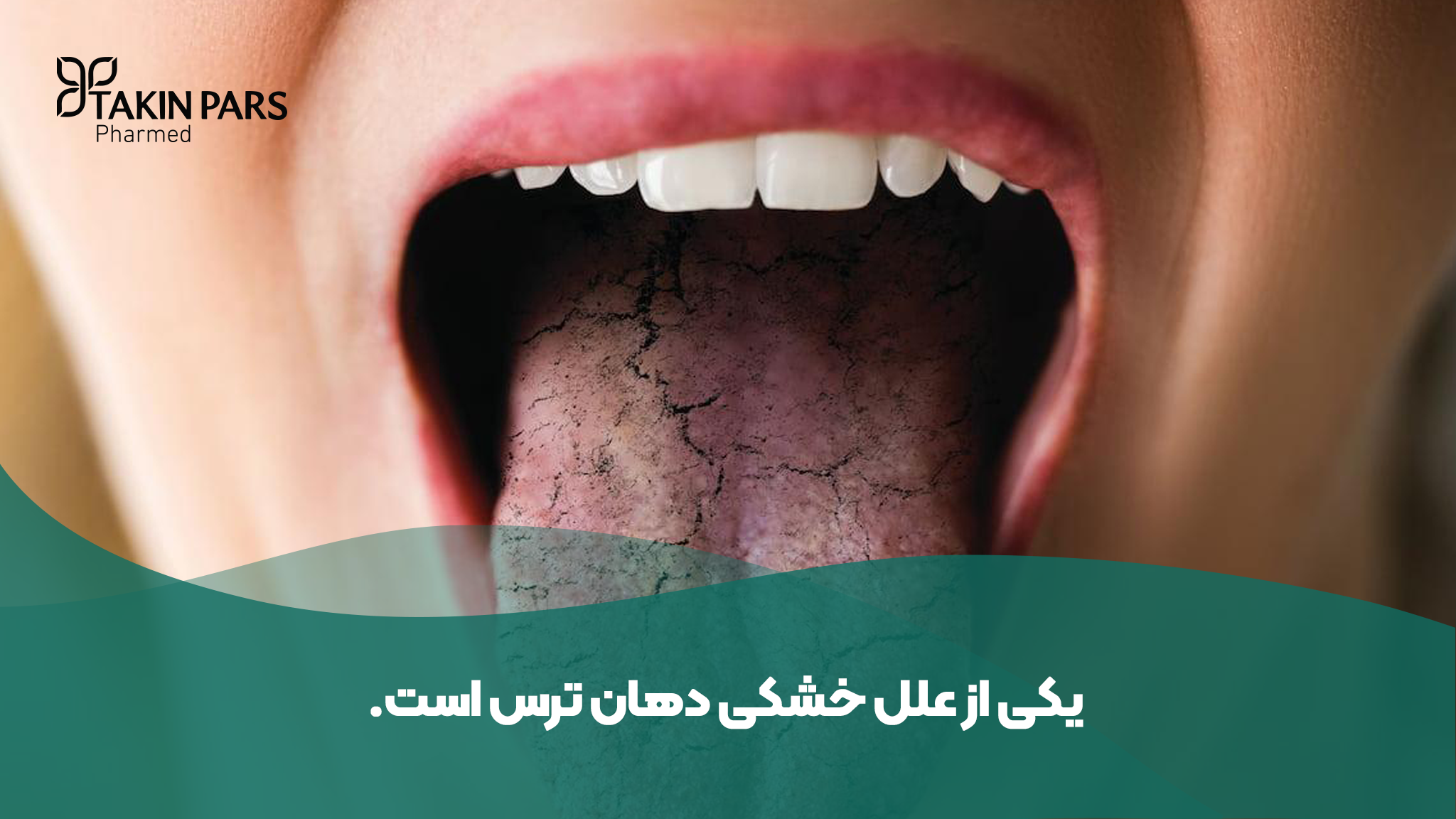 علل خشکی دهان ناشی از استرس - تکین فارمد